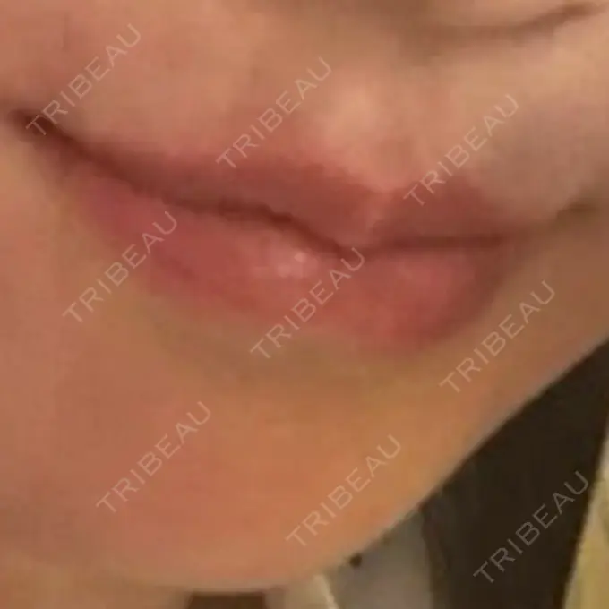 ボトックス（口角） TCB東京中央美容外科 広島院 DAY 29 メイン用