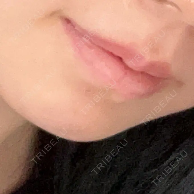 ボトックス（口角） TCB東京中央美容外科 広島院 DAY 38 メイン用