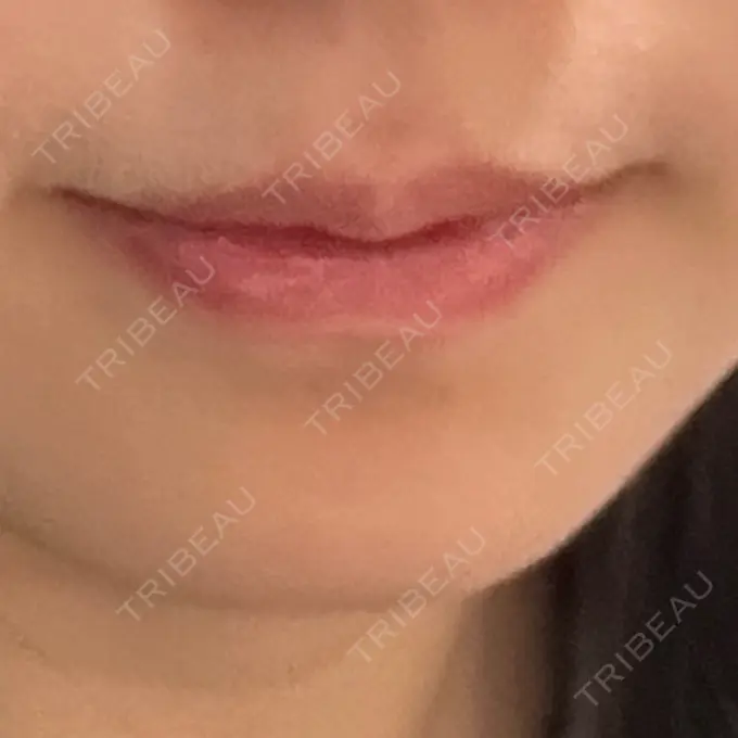 ボトックス（口角） TCB東京中央美容外科 広島院 DAY 43 メイン用