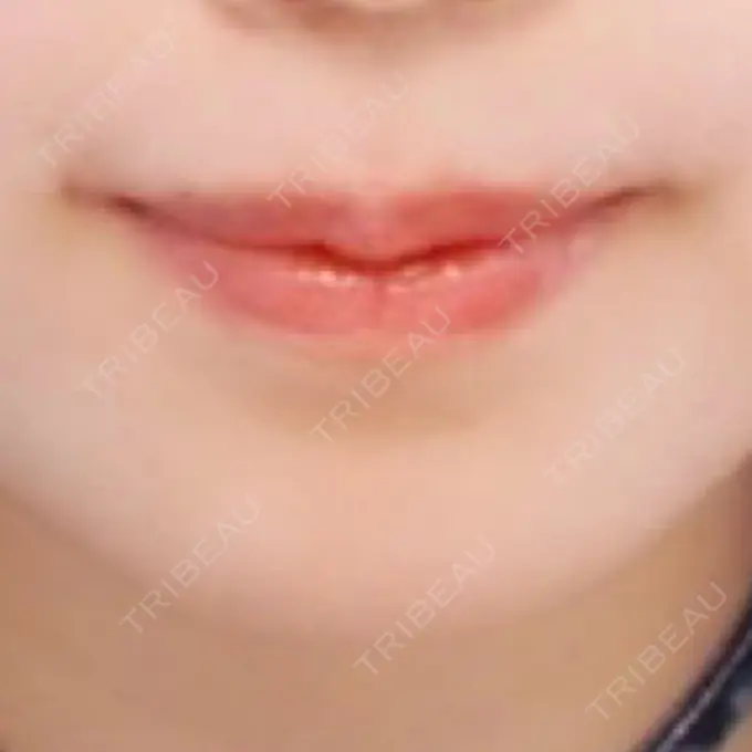 ボトックス（口角） TCB東京中央美容外科 広島院 DAY 48 メイン用