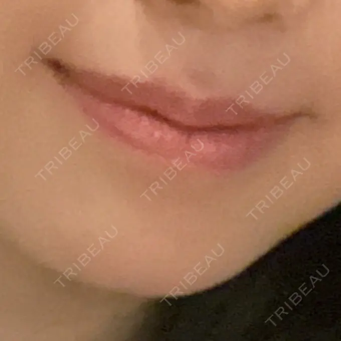 ボトックス（口角） TCB東京中央美容外科 広島院 DAY 56 メイン用