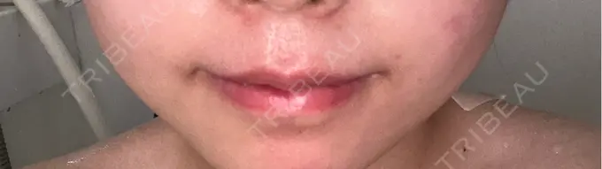 ボトックス（口角） TCB東京中央美容外科 広島院 AFTER メイン用