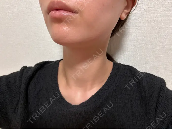 ボトックス（エラ・小顔） / ハイフ（顔） LOUIS CLINIC 二子玉川院【ルイクリニック】 AFTER メイン用