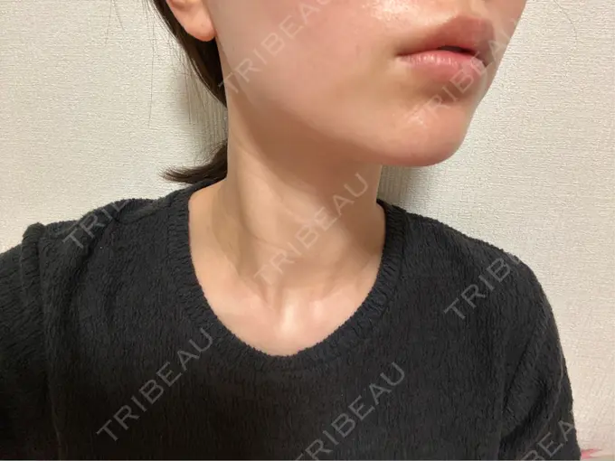 ボトックス（エラ・小顔） / ハイフ（顔） LOUIS CLINIC 二子玉川院【ルイクリニック】 DAY 0 メイン用