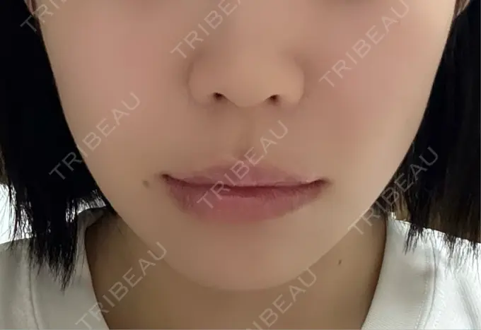 RF（高周波）たるみ治療 RIVER CLINIC（リバークリニック） AFTER メイン用