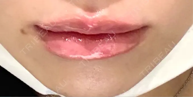 人中短縮 / 口角挙上 / ヒアルロン酸注入（唇） / その他（口元） 銀座美容外科クリニック 銀座院 DAY 0 メイン用