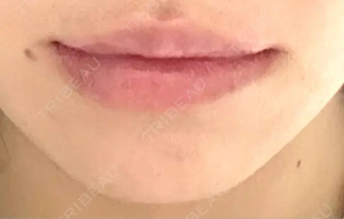 人中短縮 / 口角挙上 / ヒアルロン酸注入（唇） / その他（口元） 銀座美容外科クリニック 銀座院 DAY 0 メイン用