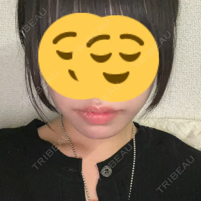 ヒアルロン酸注入（唇） / ボトックス（口角） ルラ美容クリニック 高田馬場院 AFTER メイン用