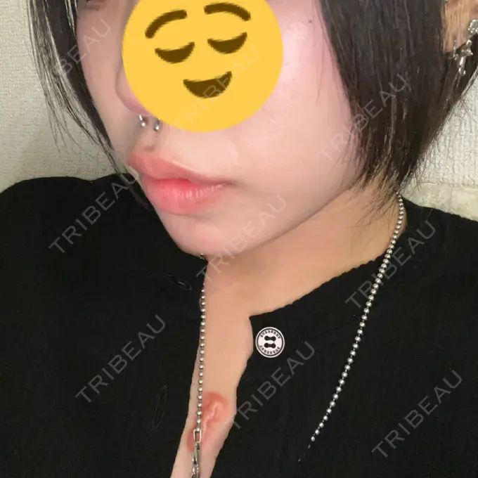 ヒアルロン酸注入（唇） / ボトックス（口角） ルラ美容クリニック 高田馬場院 DAY 0 メイン用