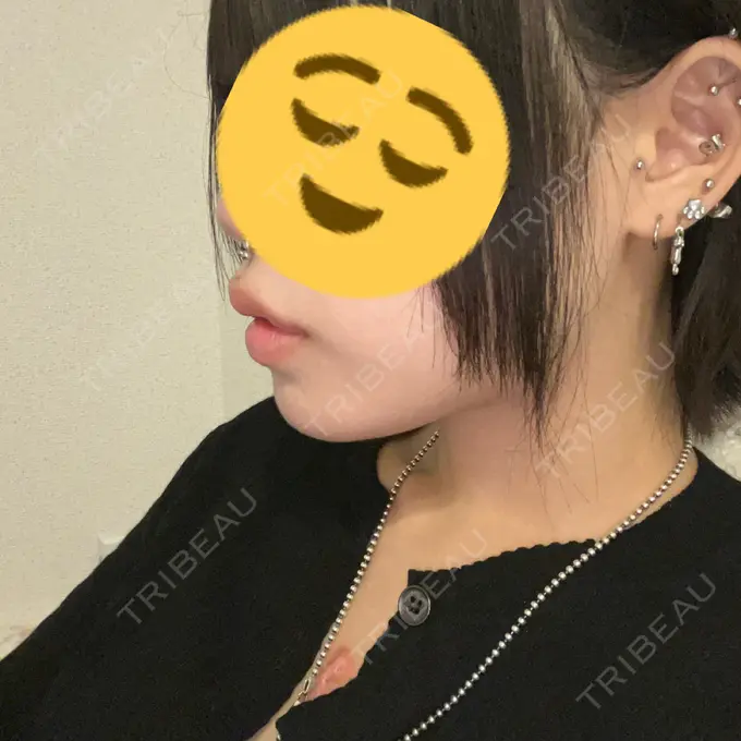 ヒアルロン酸注入（唇） / ボトックス（口角） ルラ美容クリニック 高田馬場院 DAY 0 メイン用