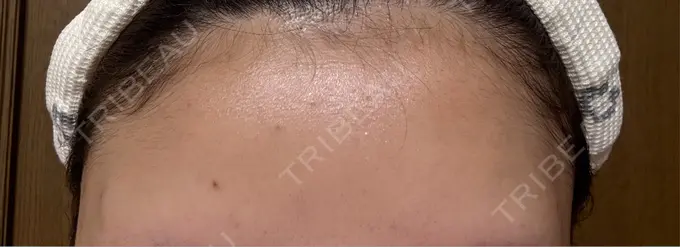 ヒアルロン酸注入（額） / ボトックス（額） アリエル美容クリニック 横浜院 DAY 1 メイン用