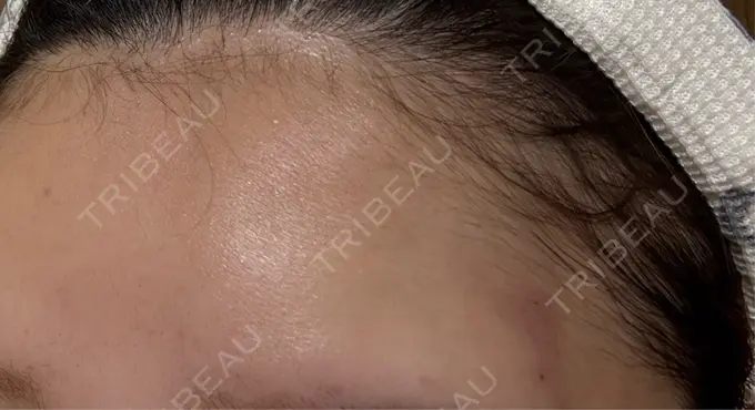 ヒアルロン酸注入（額） / ボトックス（額） アリエル美容クリニック 横浜院 DAY 1 メイン用