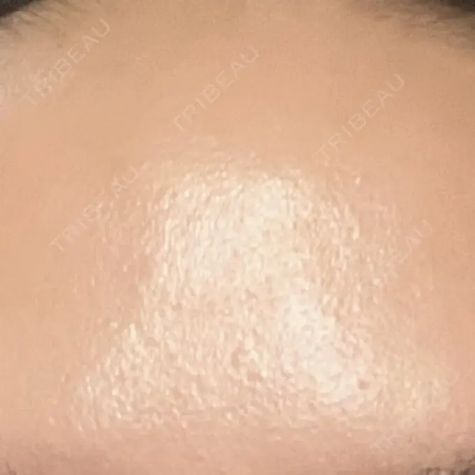 プラセンタ注射 吉祥寺アイビークリニック DAY 9 メイン用