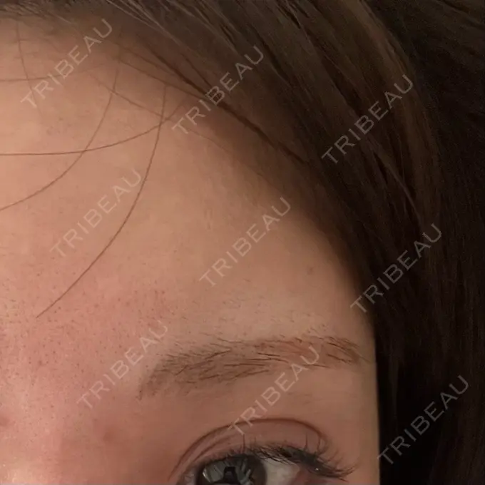 アートメイク除去・修正 ライズワン美容皮膚科クリニック DAY 12 メイン用