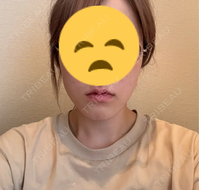 ボトックス（口角） veary clinic AFTER メイン用