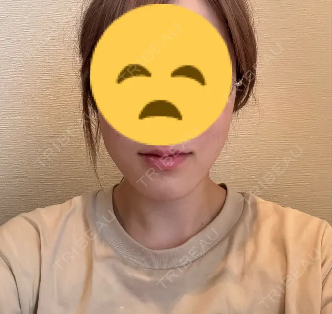 ボトックス（口角） veary clinic DAY 1 メイン用