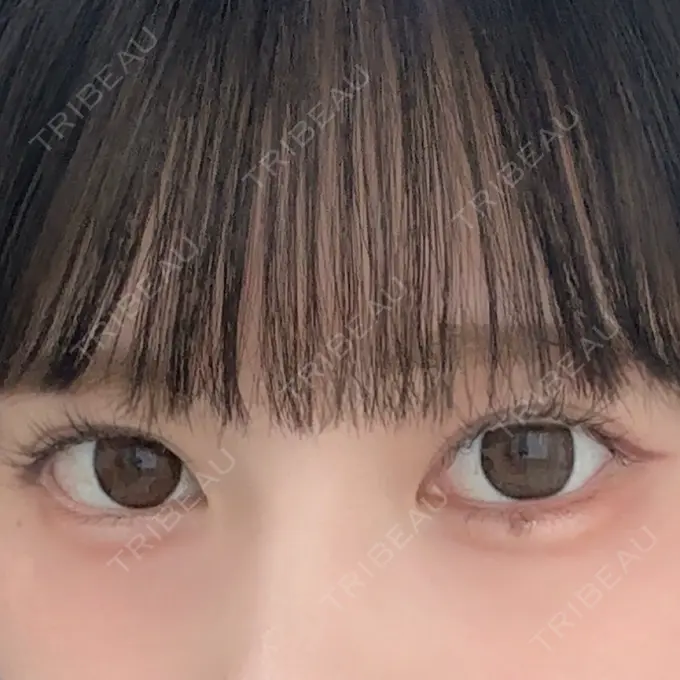 二重埋没 R Beauty CLINIC 銀座院 DAY 339 メイン用