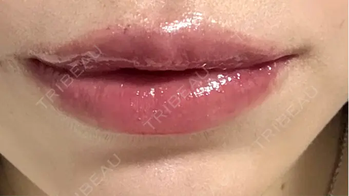 人中短縮 / 口角挙上 / ヒアルロン酸注入（唇） / その他（口元） 銀座美容外科クリニック 銀座院 AFTER メイン用