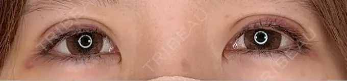 二重埋没 アリエル美容クリニック 水戸院 DAY 9 メイン用