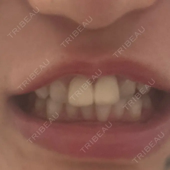 ホワイトニング 東京銀座A CLINIC デンタル DAY 0 メイン用