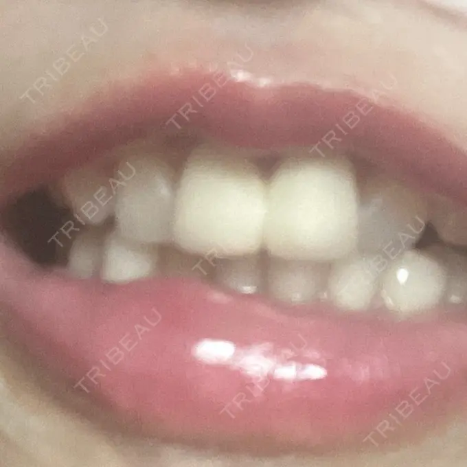 ホワイトニング 東京銀座A CLINIC デンタル DAY 1 メイン用