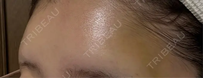 ヒアルロン酸注入（額） / ボトックス（額） アリエル美容クリニック 横浜院 DAY 2 メイン用