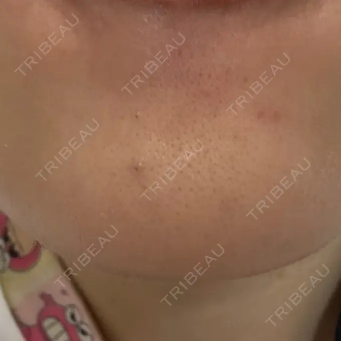 シワ取りボトックス 福岡TAクリニック DAY 20 メイン用