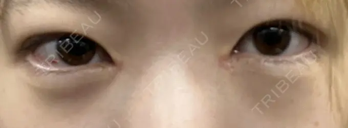 クマ治療 / ヒアルロン酸注入（目の下） BITO BEAUTY CLINIC AFTER メイン用