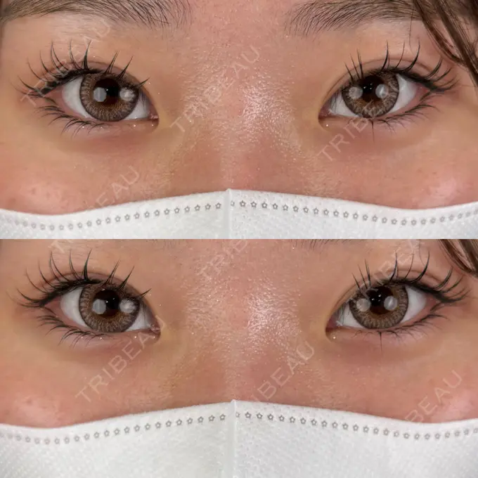 二重埋没 / 目元修正 東京シンデレラ美容外科 池袋院 AFTER メイン用