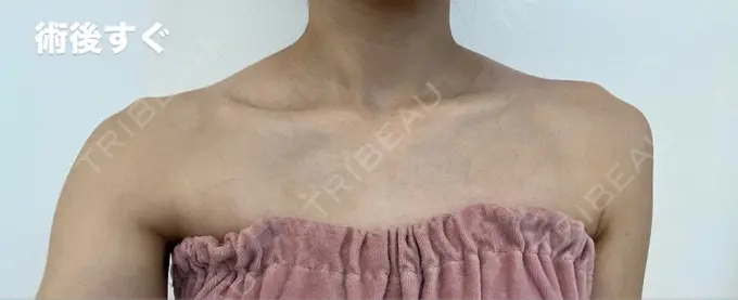 ボトックス（肩） Next Tokyo Clinic DAY 0 メイン用