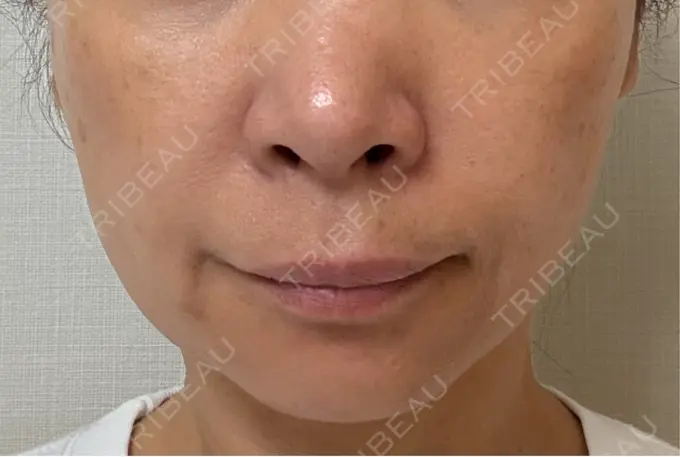 RF（高周波）たるみ治療 ゆきスキンクリニック 東池袋 DAY 6 メイン用