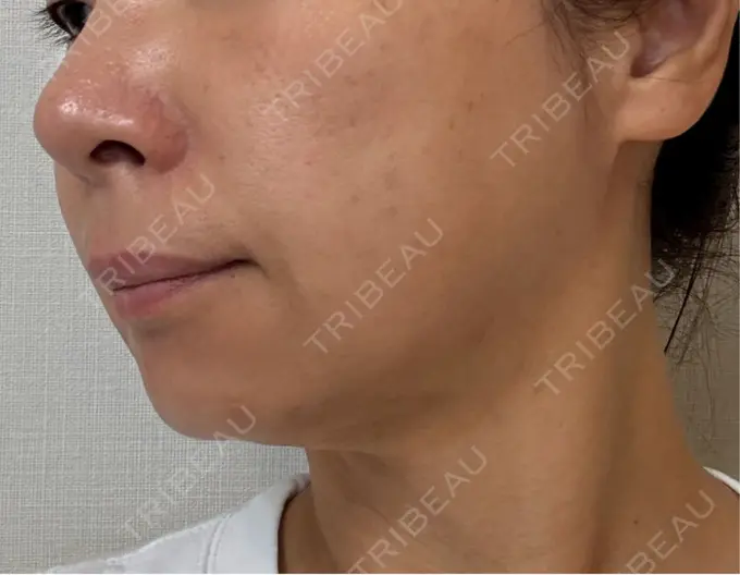 RF（高周波）たるみ治療 ゆきスキンクリニック 東池袋 DAY 6 メイン用