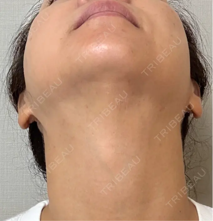 RF（高周波）たるみ治療 ゆきスキンクリニック 東池袋 DAY 6 メイン用