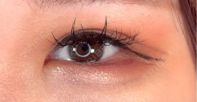 二重埋没 / ヒアルロン酸注入（涙袋） アリエル美容クリニック 横浜院 DAY 7 メイン用