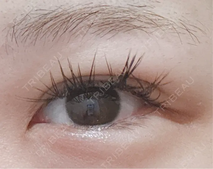 二重埋没 / ヒアルロン酸注入（涙袋） アリエル美容クリニック 横浜院 DAY 9 メイン用