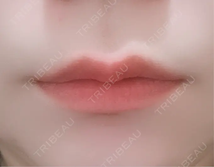 二重埋没 / ヒアルロン酸注入（涙袋） アリエル美容クリニック 横浜院 DAY 9 メイン用