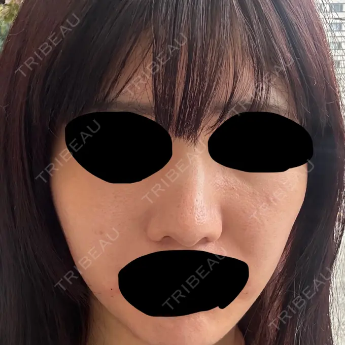 ヒアルロン酸注入（頬） THE FIRST CLINIC 町田院 DAY 0 メイン用