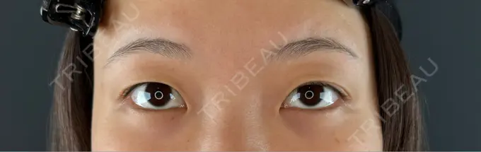 二重埋没 Brandnew Beauty Clinic DAY 0 メイン用