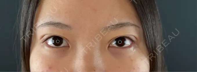 二重埋没 Brandnew Beauty Clinic DAY 0 メイン用