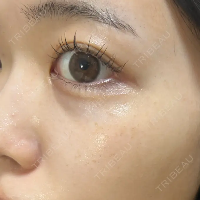 ルメッカ ゆきスキンクリニック 東池袋 DAY 5 メイン用