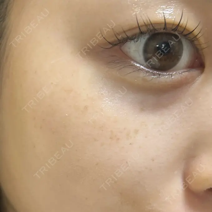 ルメッカ ゆきスキンクリニック 東池袋 DAY 5 メイン用