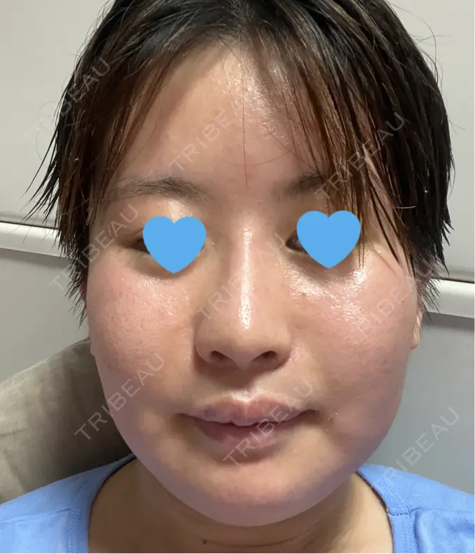 ピコレーザートーニング（美白・肝斑） 白金ビークリニック 本院 AFTER メイン用