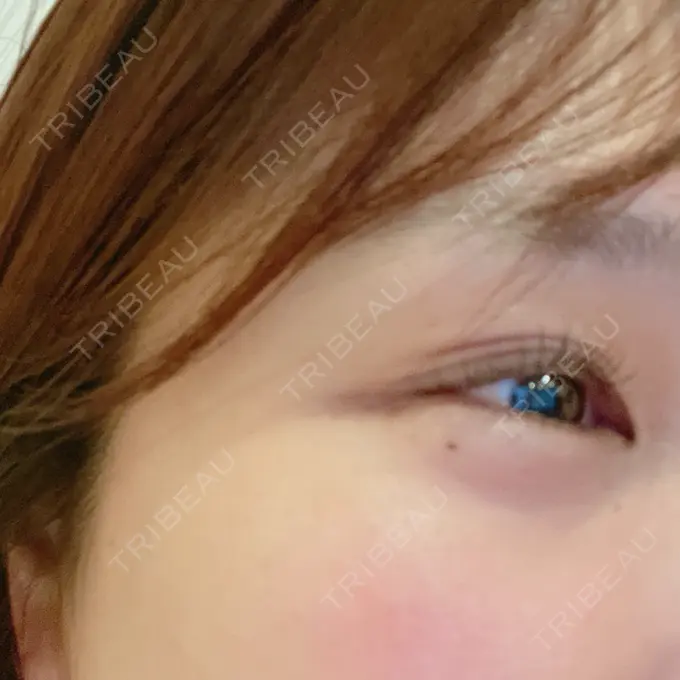 ヒアルロン酸注入（涙袋） TCB東京中央美容外科 姫路院 AFTER メイン用