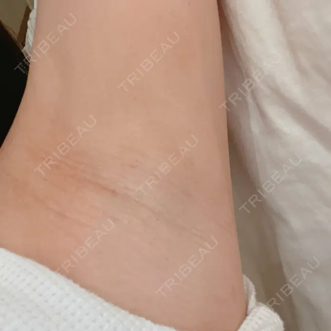 医療脱毛（ワキ） ルラ美容クリニック 神戸院 AFTER メイン用