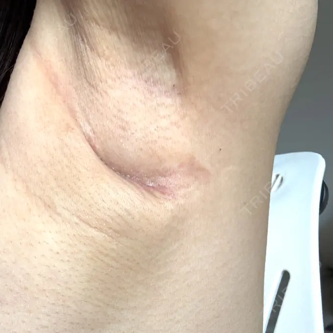 豊胸（シリコンバッグ） ルーチェクリニック 銀座院 DAY 18 メイン用