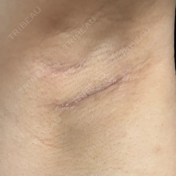 豊胸（シリコンバッグ） ルーチェクリニック 銀座院 DAY 18 メイン用