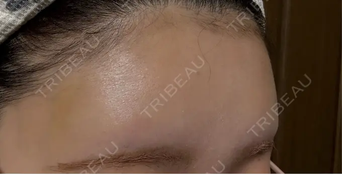 ヒアルロン酸注入（額） / ボトックス（額） アリエル美容クリニック 横浜院 AFTER メイン用