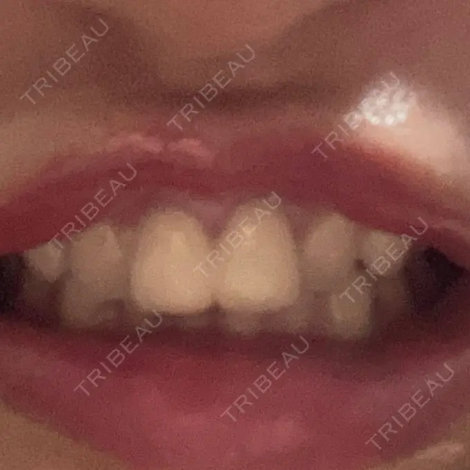 ホワイトニング 東京銀座A CLINIC デンタル DAY 2 メイン用