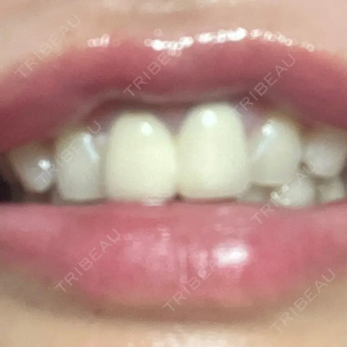 ホワイトニング 東京銀座A CLINIC デンタル DAY 3 メイン用