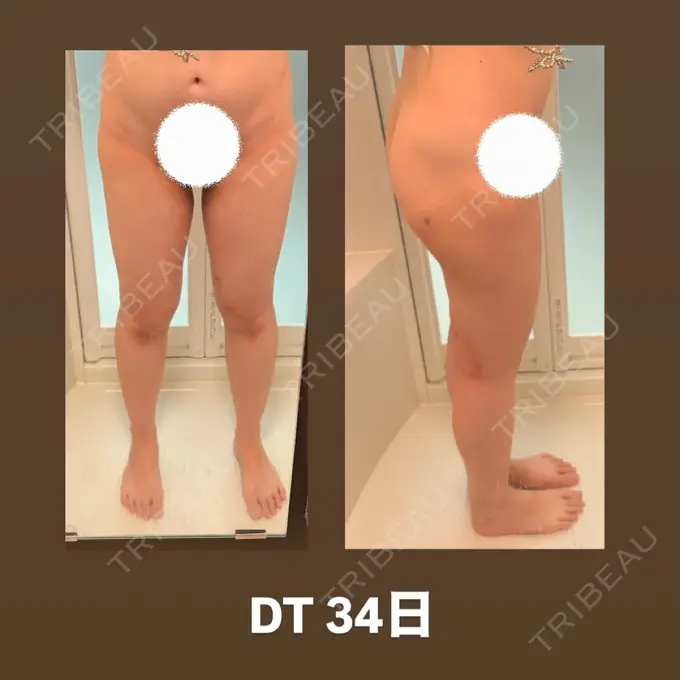 脂肪吸引（脚） 水の森美容クリニック 東京銀座院 AFTER メイン用